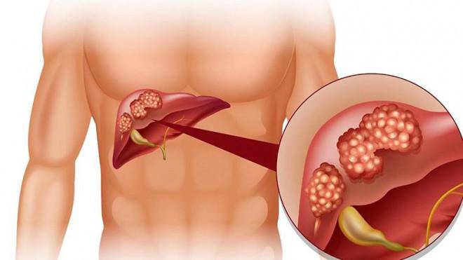 Các dấu hiệu nhận biết gan bị nhiễm độc