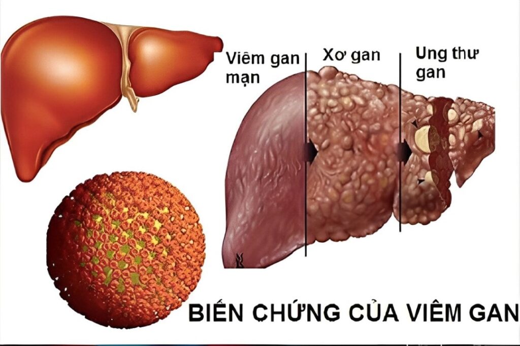 Các loại bệnh gan và đường lây nhiễm
