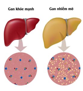 Dấu hiệu bệnh gan nhiễm mỡ mà bạn cần quan tâm